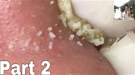 btazzees|FULL SUPER BLACKHEADS 44 MINUTES .